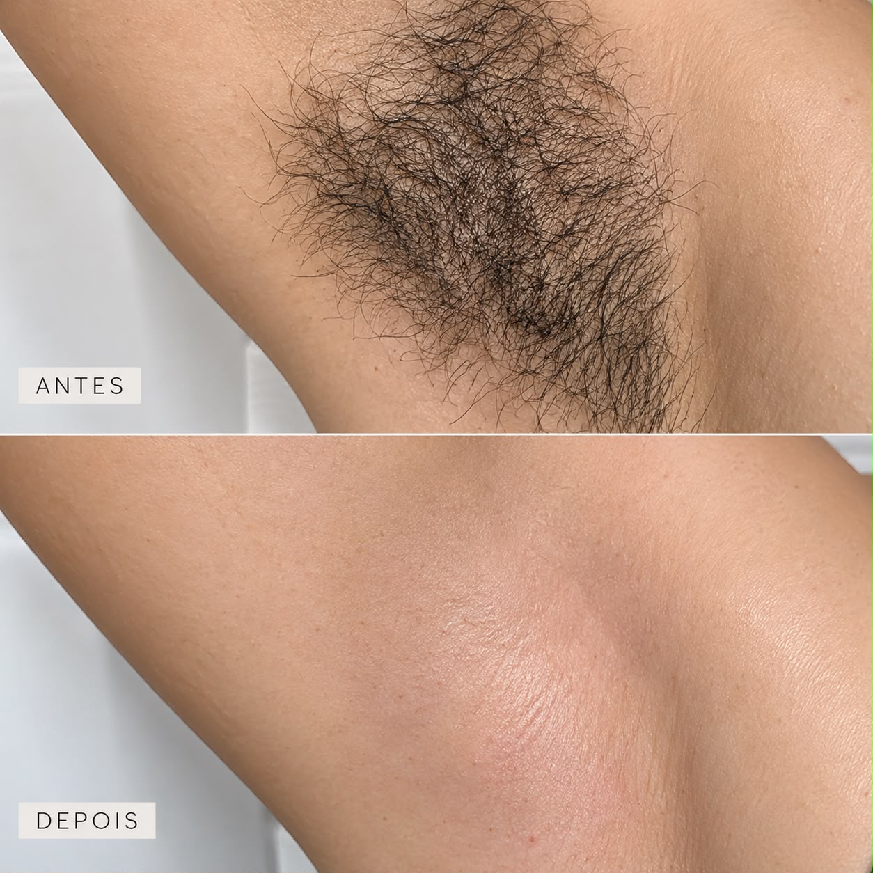 Axila antes da depilação na parte superior e depois na parte inferior, identificadas na foto.